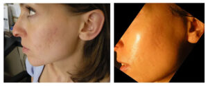 Acne scars using PRP