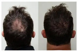 Hair Growth by Harvest PRP Injection