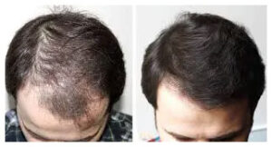 Hair Growth by Harvest PRP Injection