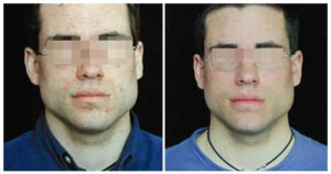 Acne using LED Light Therapy