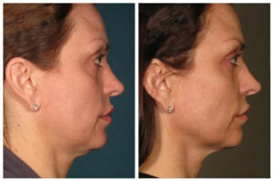 Face Ultherapy Before and 360 days After