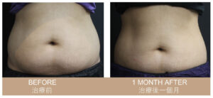 Coolsculpting Body Contouring