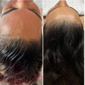 Hair growth by JetPeel and Exosomes