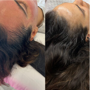 Hair growth by JetPeel and Exosomes