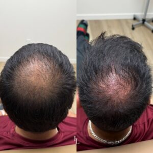 Hair growth by Sylfirm X and Exosomes