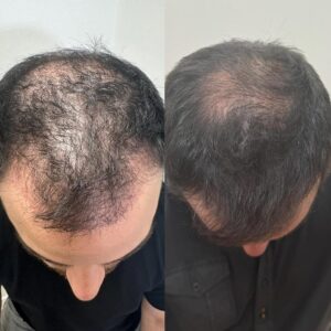 Hair growth by Sylfirm X and Exosomes